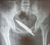 American Man Stabbed In Ass In Qianmen