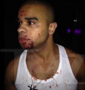 Raz B after nightclub fight