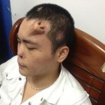 Man Grows Nose On Forehead, Just As His Surgeon Planned